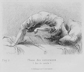 Paul Richer, Études cliniques sur le grande hystérie ou hystéro-épilepsie. Paris- Delahaye & Lecrosnier, 1881